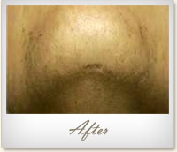 After laser hair removal on the chin