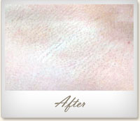 After laser hair removal on the underarm