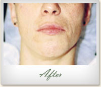 After Microdermabrasion treatment for acne