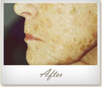 After Microdermabrasion treatment for age spots
