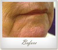 Before treatment for wrinkles on the mouth and chin