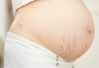 Stretch marks from pregnancy