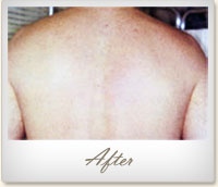 After laser hair removal on the back