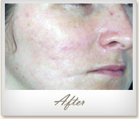 After Lutronic eCO2 treatment