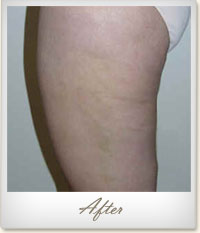 After Mesotherapy treatment for cellulite on the thighs