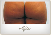 After Mesotherapy treatment for cellulite on the buttocks