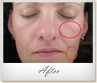After 6 Jet Peel treatments with hyaluronic acid