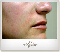 After Restylane® treatment