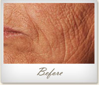 Before treatment on facial wrinkles