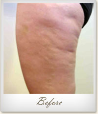 Before Mesotherapy treatment for cellulite on the thighs