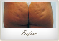 Before Mesotherapy treatment for cellulite on the buttocks