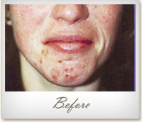 Before Microdermabrasion treatment for acne