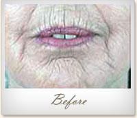 Before Restylane® treatment