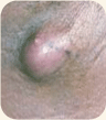 Abscess in the armpit