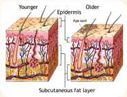 Formation of age spots as the skin ages © ADAM, Inc.