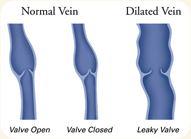 Normal vs. dilated vein