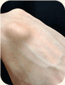 Ganglion cyst on the wrist
