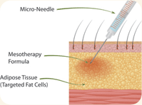 How Mesotherapy works