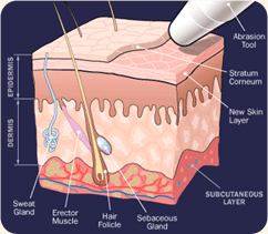How Microdermabrasion works © 2005 HowStuffWorks