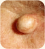 Sebaceous cyst on the face
